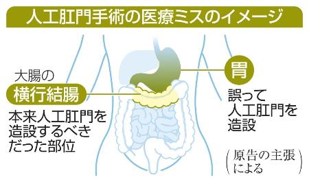 人工肛門手術の医療ミスのイメージ