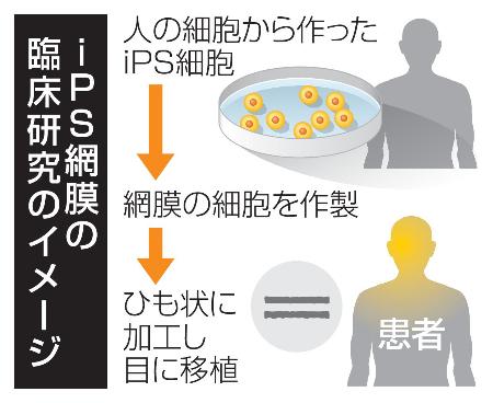 　ｉＰＳ網膜の臨床研究のイメージ