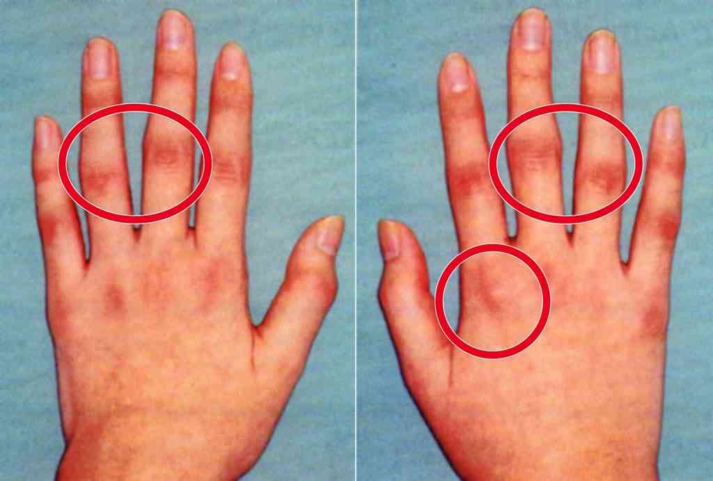 関節リウマチの初発症状の例。朝にこわばり感があり、中指や薬指の第２手指関節が両手とも腫れ、右人さし指の第３手指関節が左に比べて腫れている（中村医師提供）