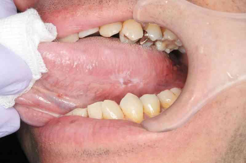 男性（４８）の舌に生じた早期舌がんの口腔内。左側舌縁部に紅白混在型の病変が認められる。ただれた部分（紅斑部）には歯の鋭縁が当たっていたものと思われる（中山秀樹さん提供）