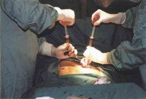 注射器で骨盤から骨髄液を採取する様子（日本骨髄バンク提供）