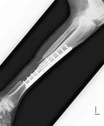 手術後の左下肢のレントゲン写真