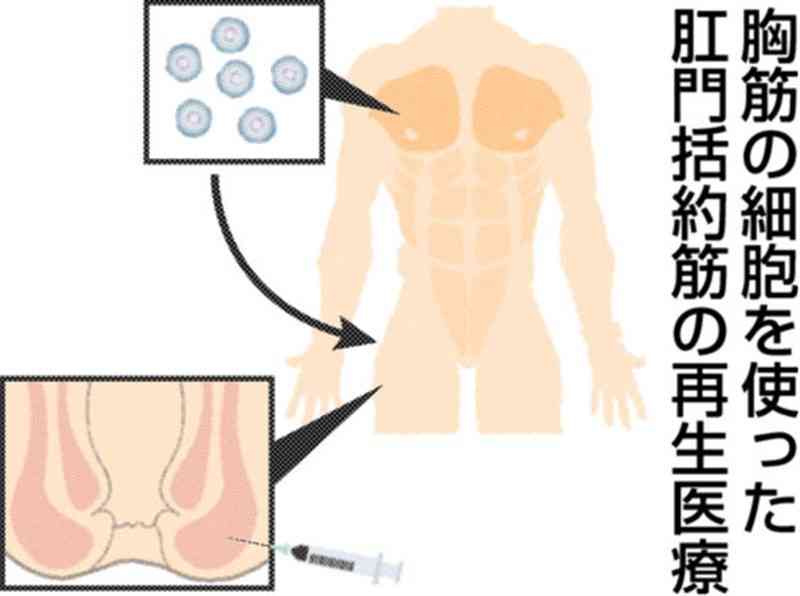 便失禁改善へ「再生医療」　高野病院（熊本市）で治験進む　胸筋の細胞使用「新たな選択肢に」