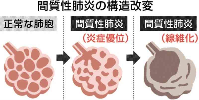 増える間質性肺炎、早期発見を　乾いたせき、息切れの症状　済生会熊本病院・一門医師に聞く